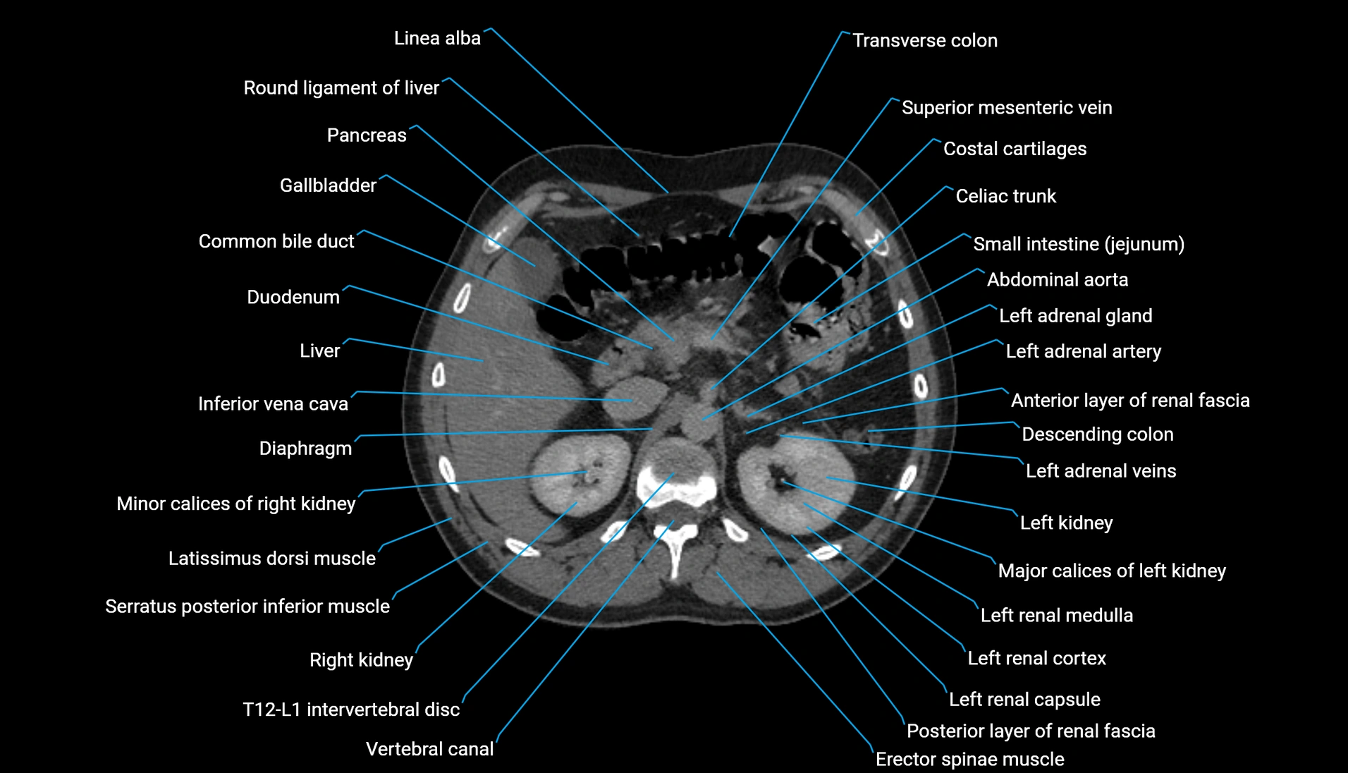 CT urogram axial cross sectional anatomy  labelled radiology image-00086.webp